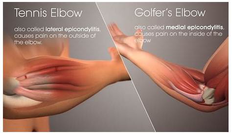 elbow pain diagram