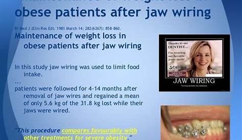 Wiring Jaw Shut For Weight Loss
