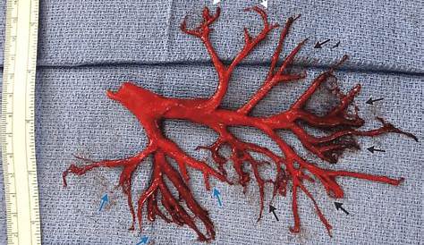 Man dying from heart failure coughs up blood clot shaped like lung