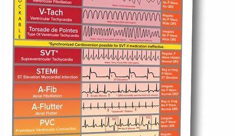 Ekg Interpretation Cheat Sheet / EKG/ECG Cheat Sheet | Nursing tips