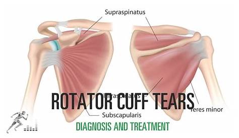Rotator cuff tear: Signs and symptoms, diagnosis and treatment options