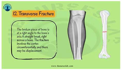 Types of Bone Fracture