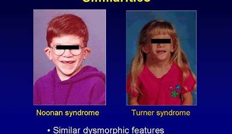 To Treat or Not to Treat: Short Stature in Noonan Syndrome (Transcript)