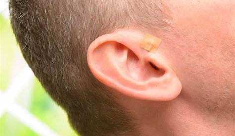where to place acupuncture ear seeds