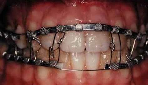 What is Dental Splinting Types, Objectives, Indications and