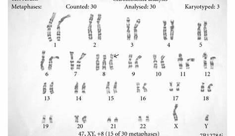 Karyotyping showing trisomy 8. | Download Scientific Diagram