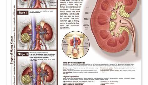 18 Inspirational Kidney Tumor Size Chart