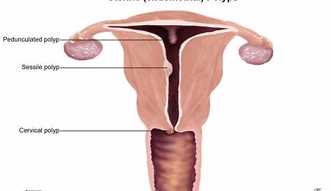endometrial polyp size chart