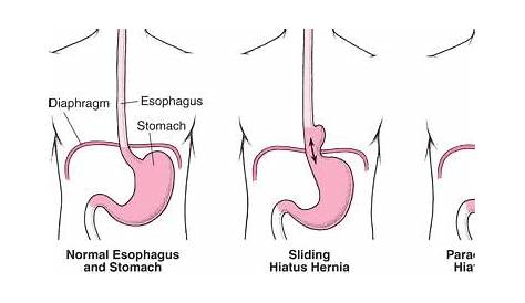 what size is a small hiatal hernia