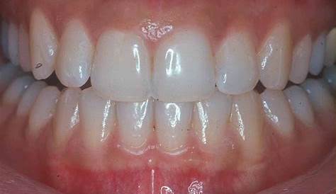 Gum Diseases - Michael E. Krone, D.D.S. Family Dentistry