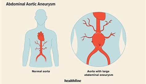 Abdominal Aortic Aneurysm: Causes, Treatment, and Prevention