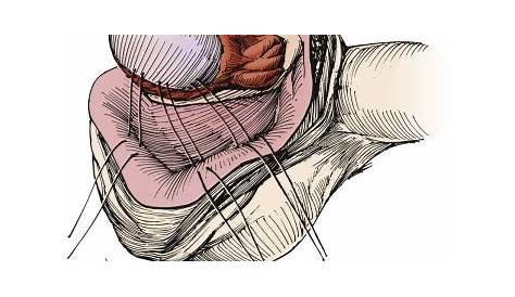 manual reduction of testicular torsion