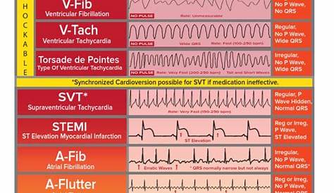 Basic EKG ECG Rhythms Cheatsheet | Electrocardiography | Cardiac