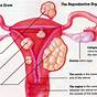 Uterine Fibroids Size Chart