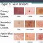 Types Of Skin Lesions Chart