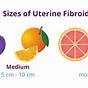 Uterine Fibroid Size Chart In Cm