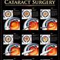 Eye Drop Chart For Cataract Surgery