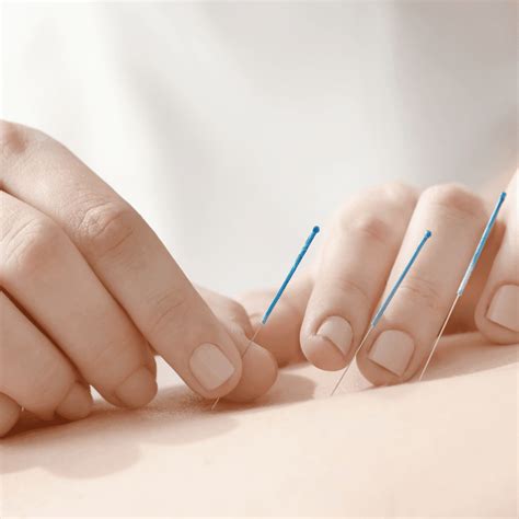 Acupuncture