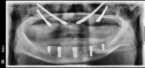 Implantes Zigomáticos y Quad Zygoma: Soluciones Avanzadas | Lema Dental ...