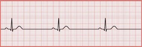 EKG Bradycardias and Heart Blocks I and II Flashcards | Quizlet