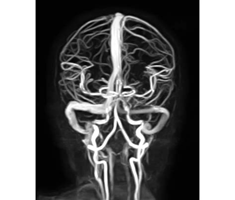 Philips - Compressed SENSE MR Clinical Applications - Philips