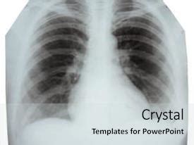 Radiation Therapy X Ray Picture Showing PPT template 18 | CrystalGraphics
