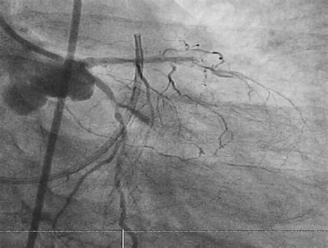 Percutaneous Coronary Intervention (PCI) Strategies under Hemodynamic ...