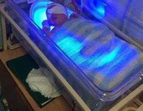 Jaundice: Phototherapy for neonatal jaundice (1047) | Right Decisions