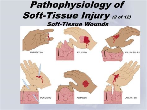 Soft Tissue Injury Foot Treatment