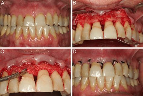 A Clinical View After Basic Periodontal Therapy B Widman Surgical