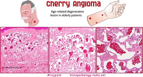 Pathology Of Cherry Angioma Senile Angioma Campbell De Morgan Spots