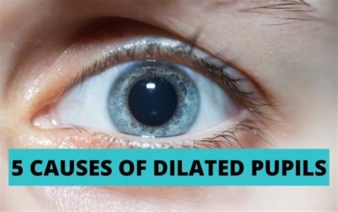 Dilated Pupils When To Be Concerned