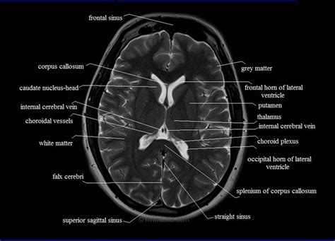Mri Anatomy Brain Axial Image 16 Brain Anatomy Radiology Radiology