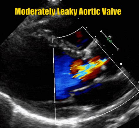 Aortic Valve Sclerosis With Mild Aortic Regurgitation Doctorvisit