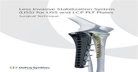 Less Invasive Stabilization System Liss For Liss And Lcp Plt Synthes
