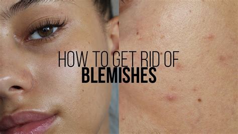 How To Get Rid Of Blemishes In 3 Days Jessicvpimentel Youtube