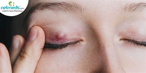Chalazion Meibomian Cyst Eyelid Cyst Causes Symptoms And Treatment