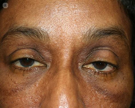 All About Ptosis Drooping Or Falling Upper Eyelids Top Doctors