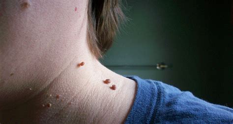 Por Qué Salen Las Verrugas En El Cuello Y Cómo Eliminarlas • Skingroup