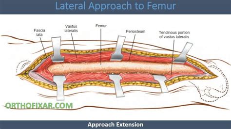 Lateral Approach To Femur • Full And Easy • Orthofixar 2024