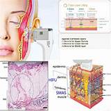 Pictures of Hifu Treatment For Face Side Effects