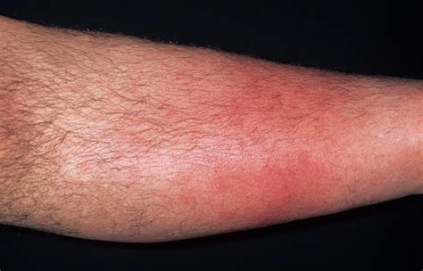 Recurrent Cellulitis Etreaifts