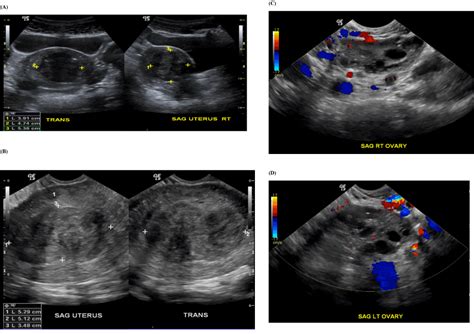 Ultrasound scans use high frequency sound waves to create a picture of your ovaries. Case report: Ovarian cortex and stroma on an endometrial ...