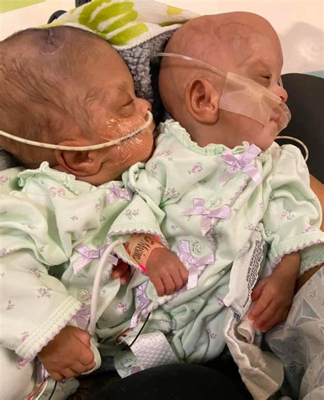 Astonishing Photos Show Birth Of Second Most Premature Twins Ever To Survive News News Metro