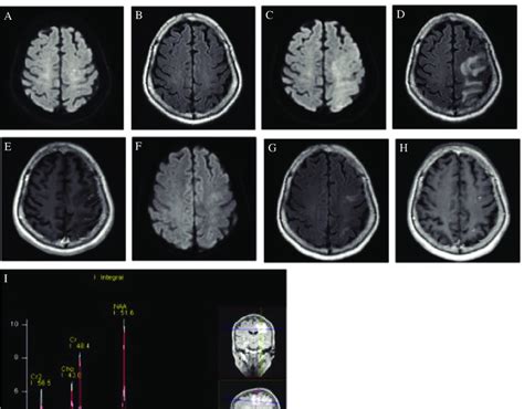 Findings Of Brain Mri And Mrs In Case 3 A And B Pod 1 Mri Shows A