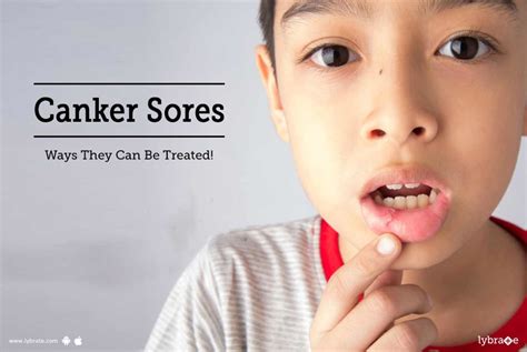 Canker Sores Ways They Can Be Treated By Dr Jagatjit Singh Kohli