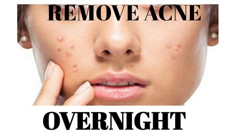 What is an overnight face mask? DIY/HOMEMADE FACE MASK FOR ACNE | ACNE TREATMENT OVERNIGHT ...