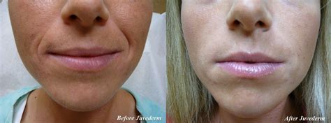 Before And After Juvederm To The Nasolabial Folds Around The Mouth