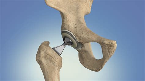 What Causes The Need For Hip Replacement Diversityinhospitality
