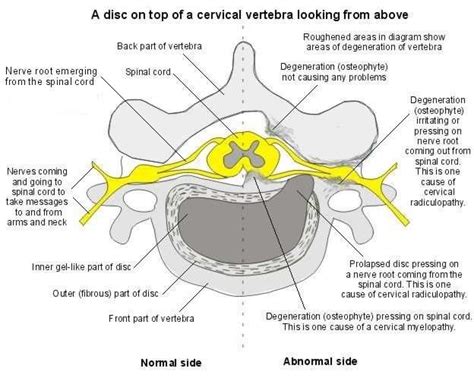 Cervical Spondylosis What Is Cervical Spondylosis And Symptoms